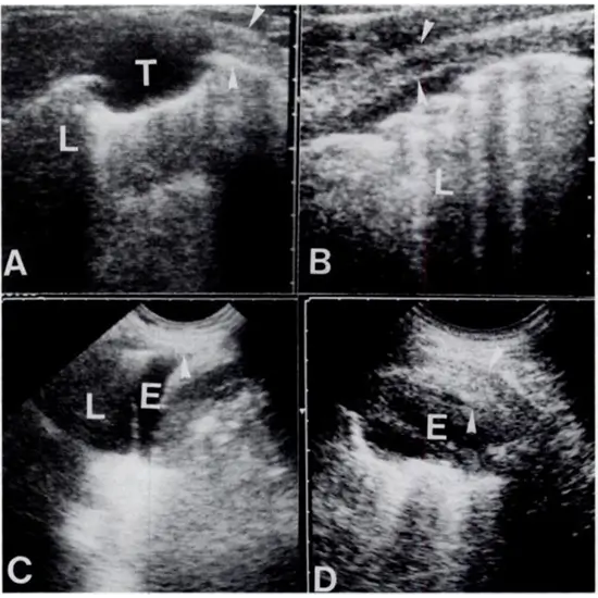 Ultrasound Guided Pleural